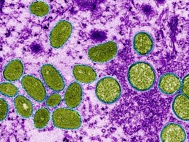 Haiti - FLASH : A suspected case of monkeypox discovered in the Artibonite