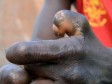 Haiti - Health : 50 new cases of leprosy in the country