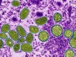 Haiti - Monkey Pox : The Ministry raises the level of alert in the country